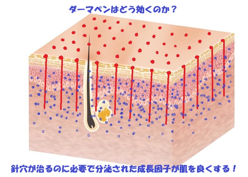 ダーマペンの効果イラスト