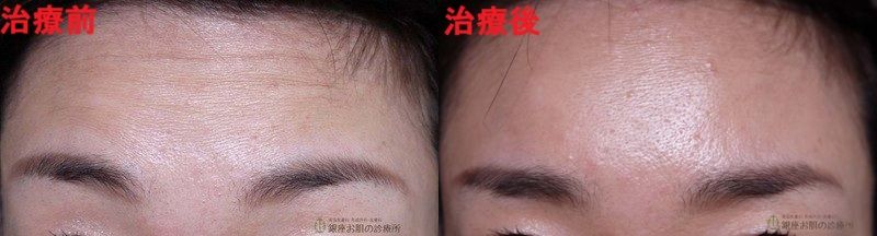 額ボトックスビフォーアフター