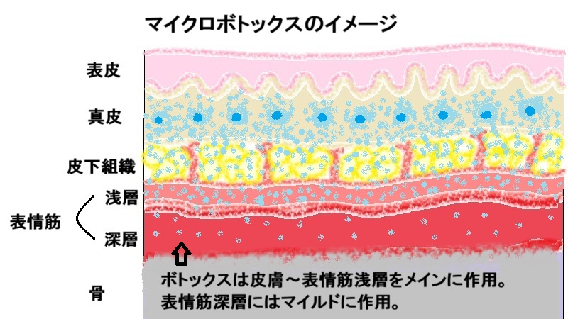マイクロボトックスイメージ(Microdroplet technique)