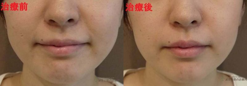小顔ボトックス（マイクロボトックス＋エラボトックス）ビフォーアフター