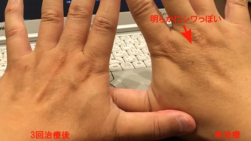 マッサージピール手のシワ比較①