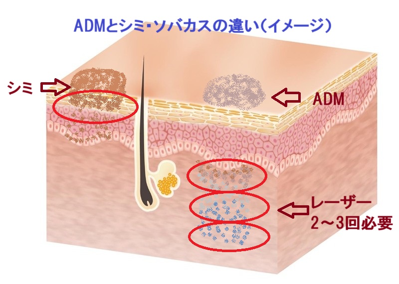 ADM皮膚断面図イラスト