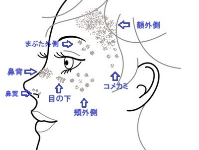 ADM好発部位イラスト