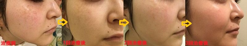 ADM右側経過
