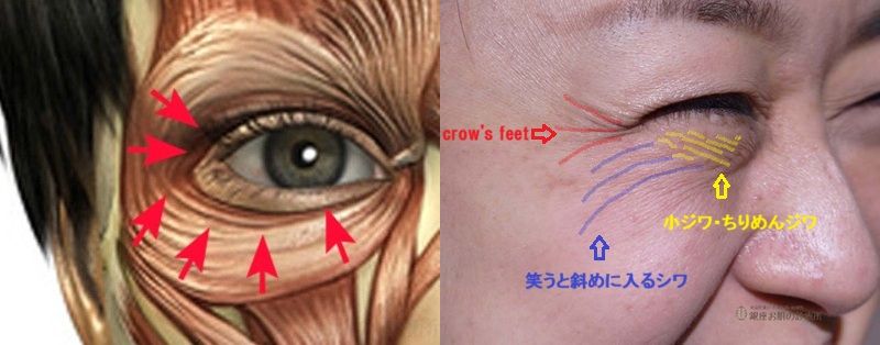 目尻・目の下のシワの特徴