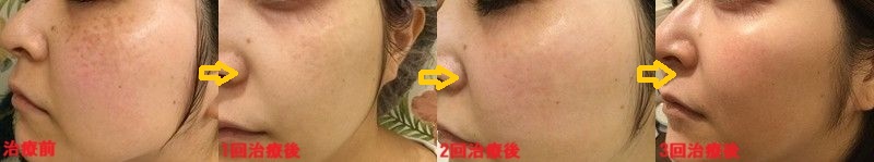 ADM左側経過