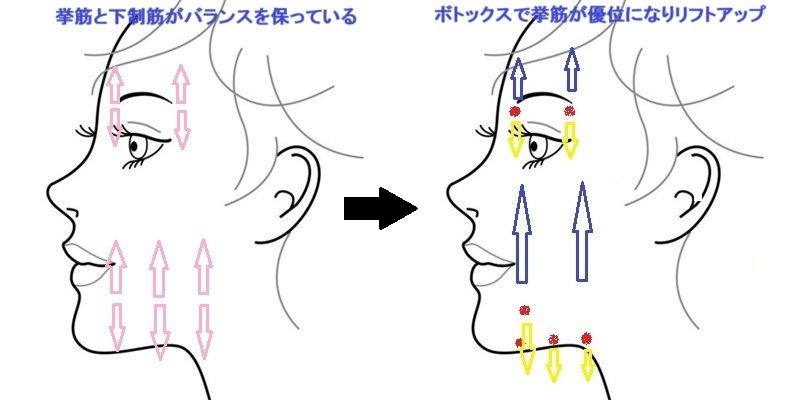 ボトックスリフトイラスト
