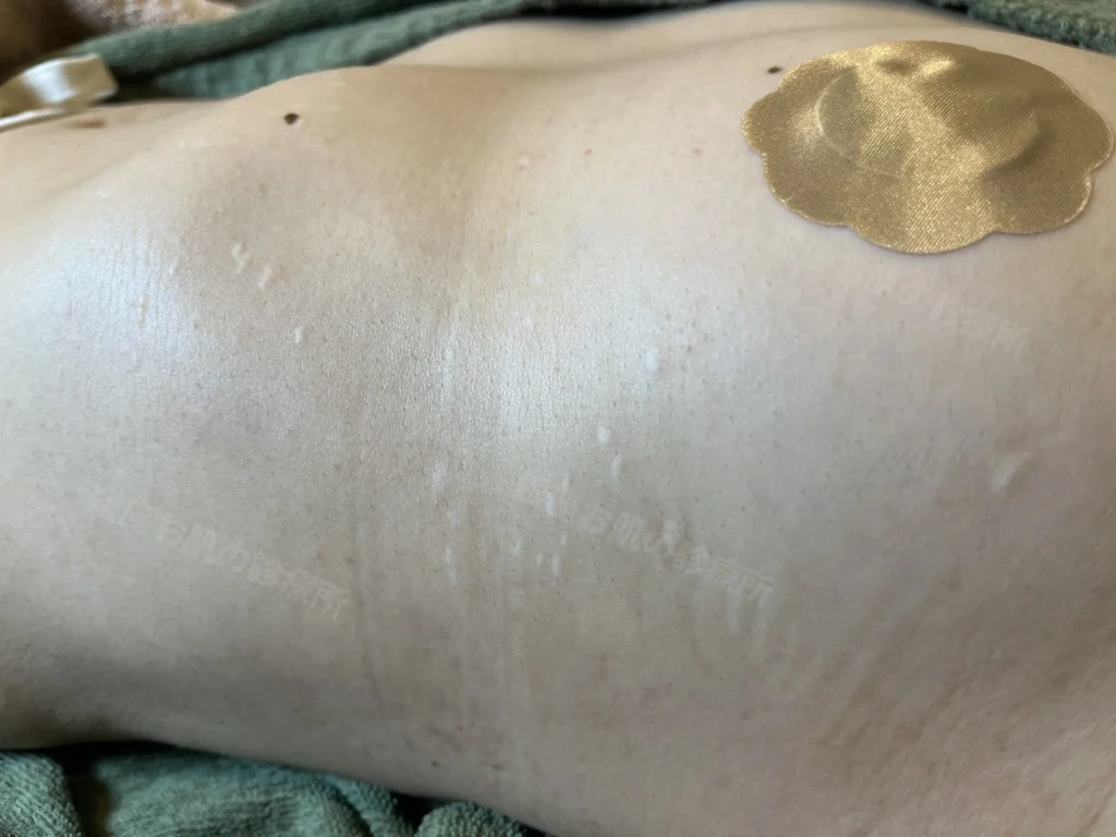 身体(胸~腹部)の脂漏性角化症の治療後。ホクロ以外の脂漏性角化症はほぼ除去され、肌表面が滑らかになった状態。