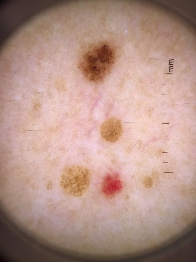 脂漏性角化症のダーモスコピー所見。色素性母斑や老人性血管腫も混在。