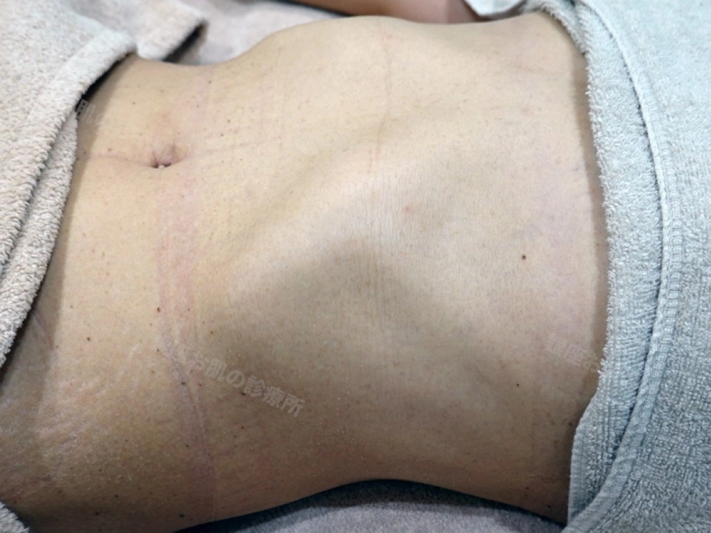 腹部の脂漏性角化症のレーザー治療1ヶ月後。目立つ炎症後色素沈着はみられず、良好に経過している状態。下腹部は未治療なので、小さな脂漏性角化症が散在している