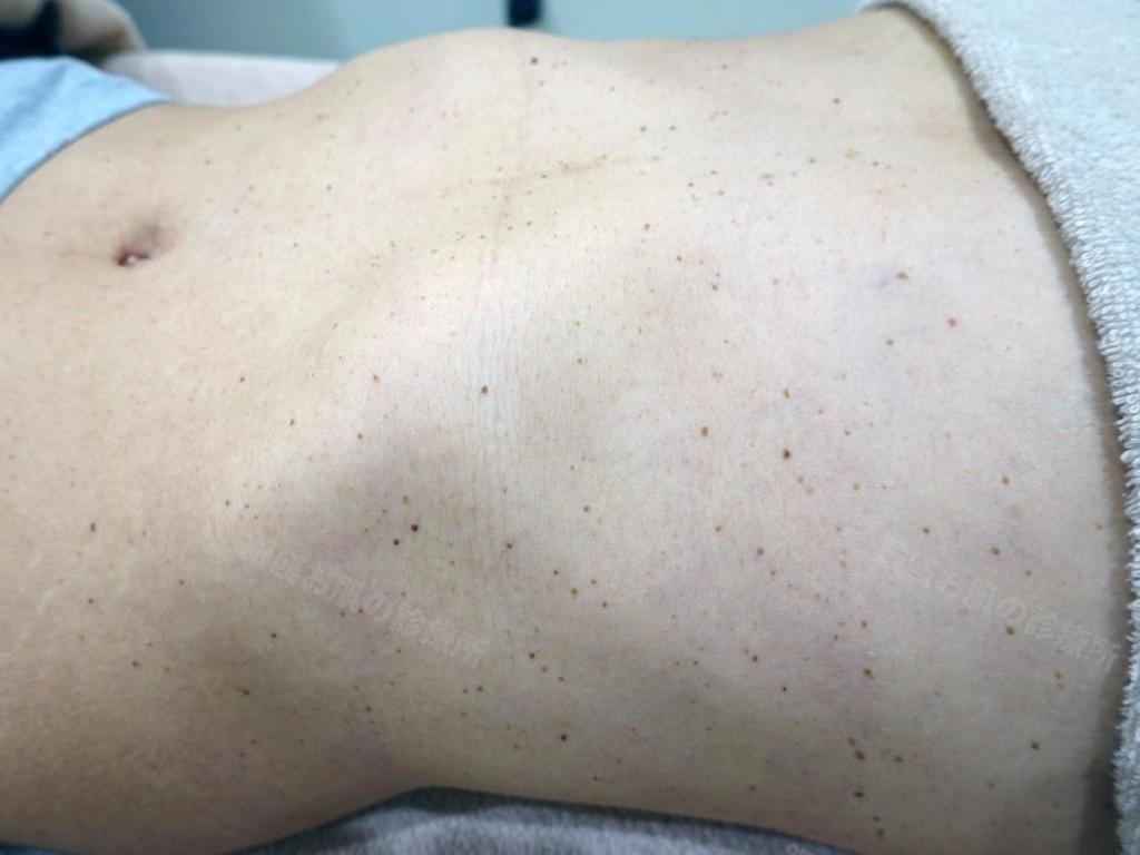 腹部の脂漏性角化症のレーザー治療前。小さな脂漏性角化症が多数散在している状態