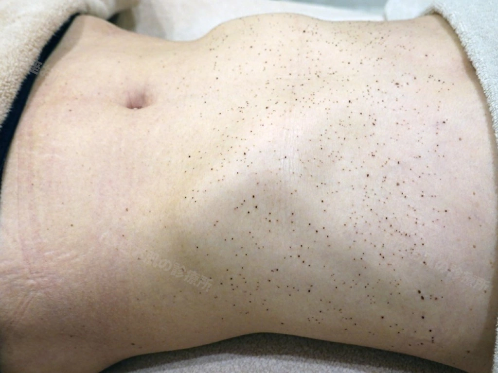 腹部の脂漏性角化症のレーザー治療3日後。多数の治療部位にかさぶたが形成され、目立つ赤みはみられない状態