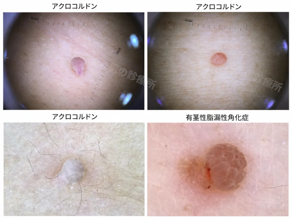 複数のアクロコルドンと有茎性脂漏性角化症の比較画像。いずれも有茎性だが、表面の性状などに微妙な違いがみられる。脂漏性角化症では、cerebriform patternやfissures/ridgeが見られる。