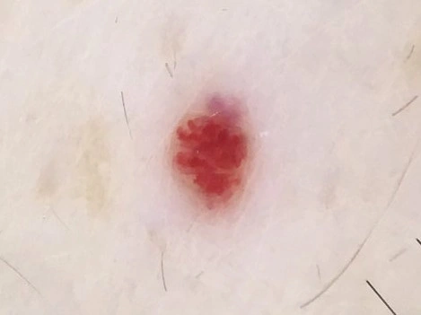 老人性血管腫の拡大写真。赤い血管が房状に集まって見え、隣に小さな脂漏性角化症がみられる