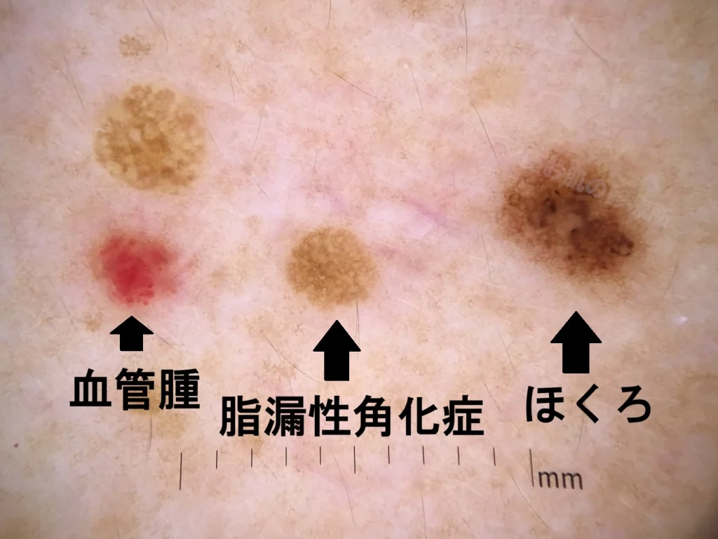 老人性血管腫、脂漏性角化症、ほくろ（色素性母斑）が同じ皮膚上にみられる臨床画像。それぞれ異なる色調や形態を示している。