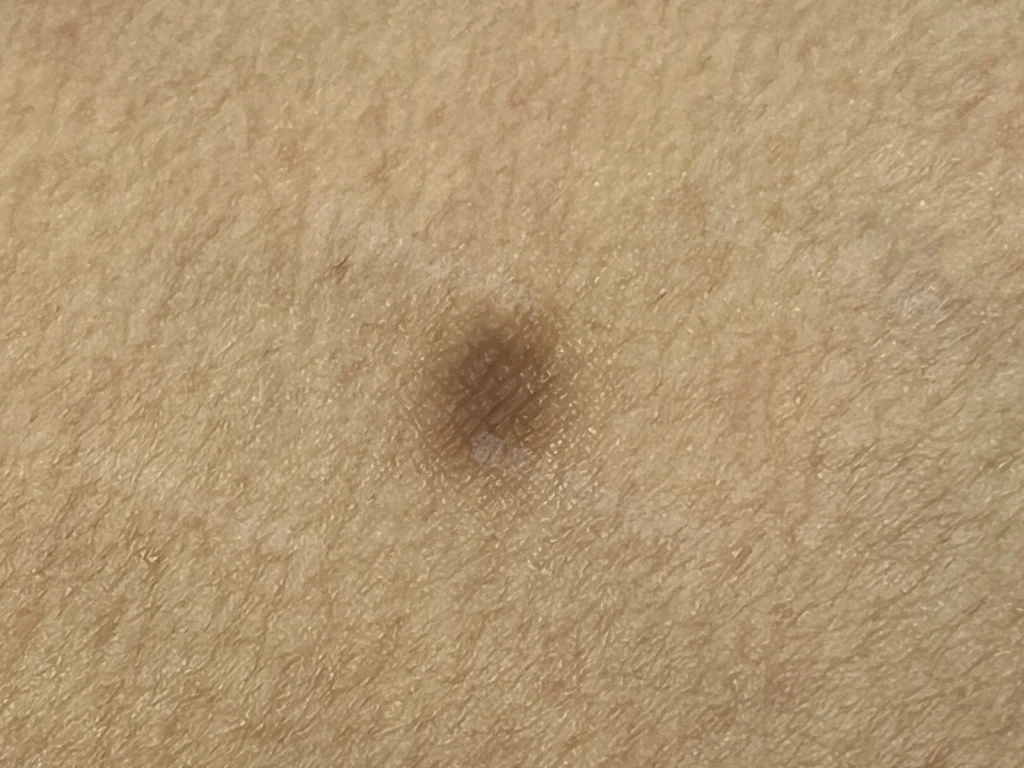 下肢に生じた皮膚線維腫の臨床画像。皮膚に硬く盛り上がった小さな結節がみられる。