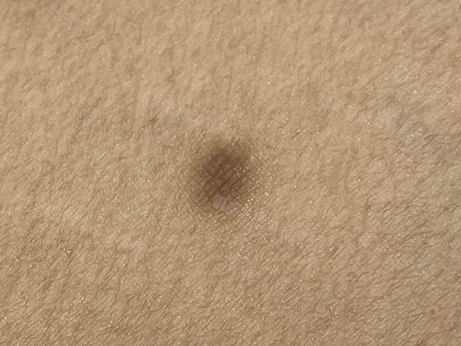 下肢に生じた皮膚線維腫の臨床画像。皮膚に硬く盛り上がった小さな結節がみられる。