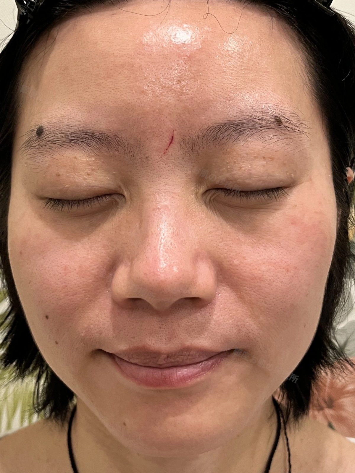 脂漏性角化症のレーザー治療10ヶ月後。炎症後色素沈着が消失し、肌の色調が改善した状態