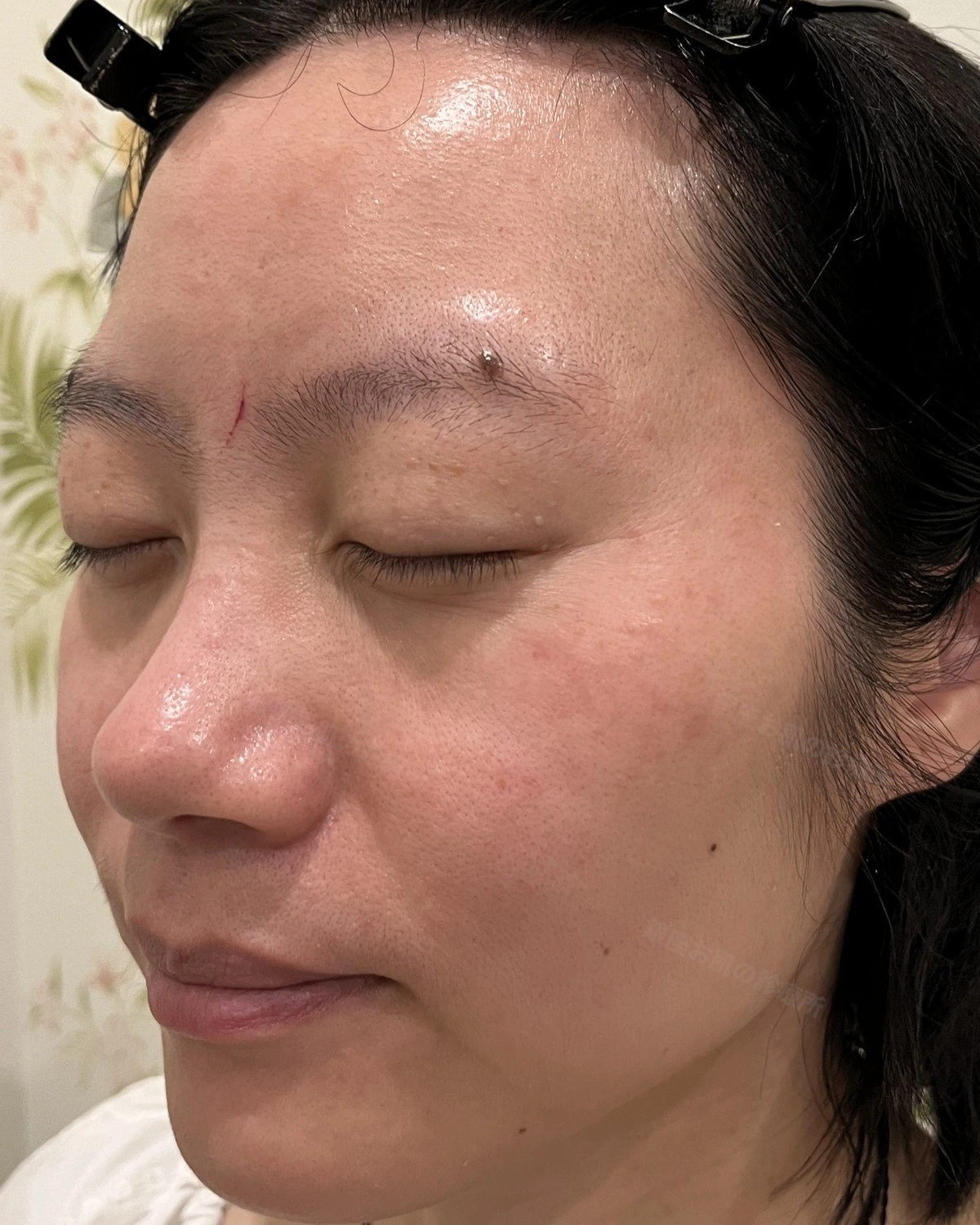顔の脂漏性角化症のレーザー治療後。左斜めから見た顔で脂漏性角化症がみられなくなった状態