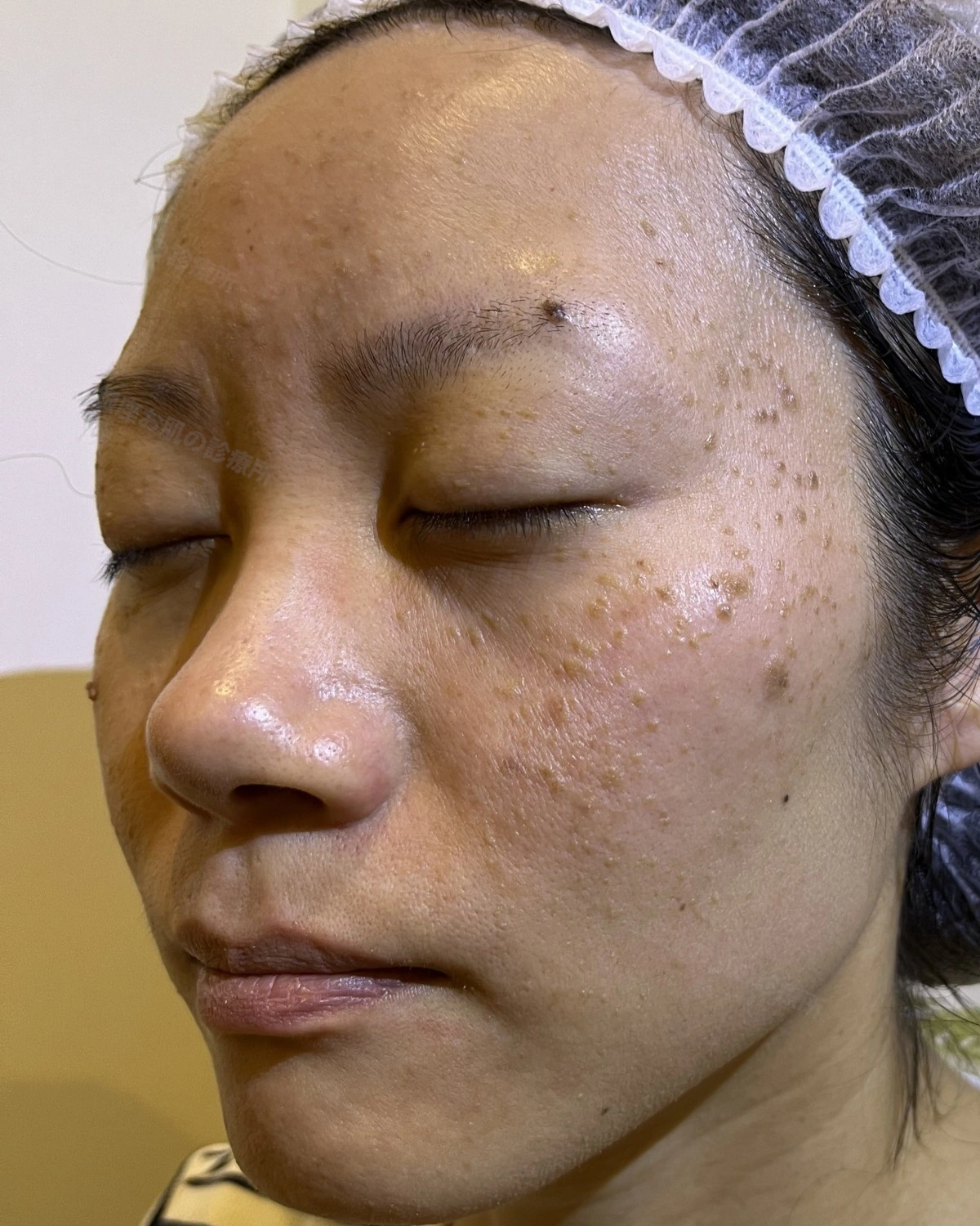 顔の脂漏性角化症のレーザー治療前。左斜めから見た顔に多数の脂漏性角化症がみられる状態
