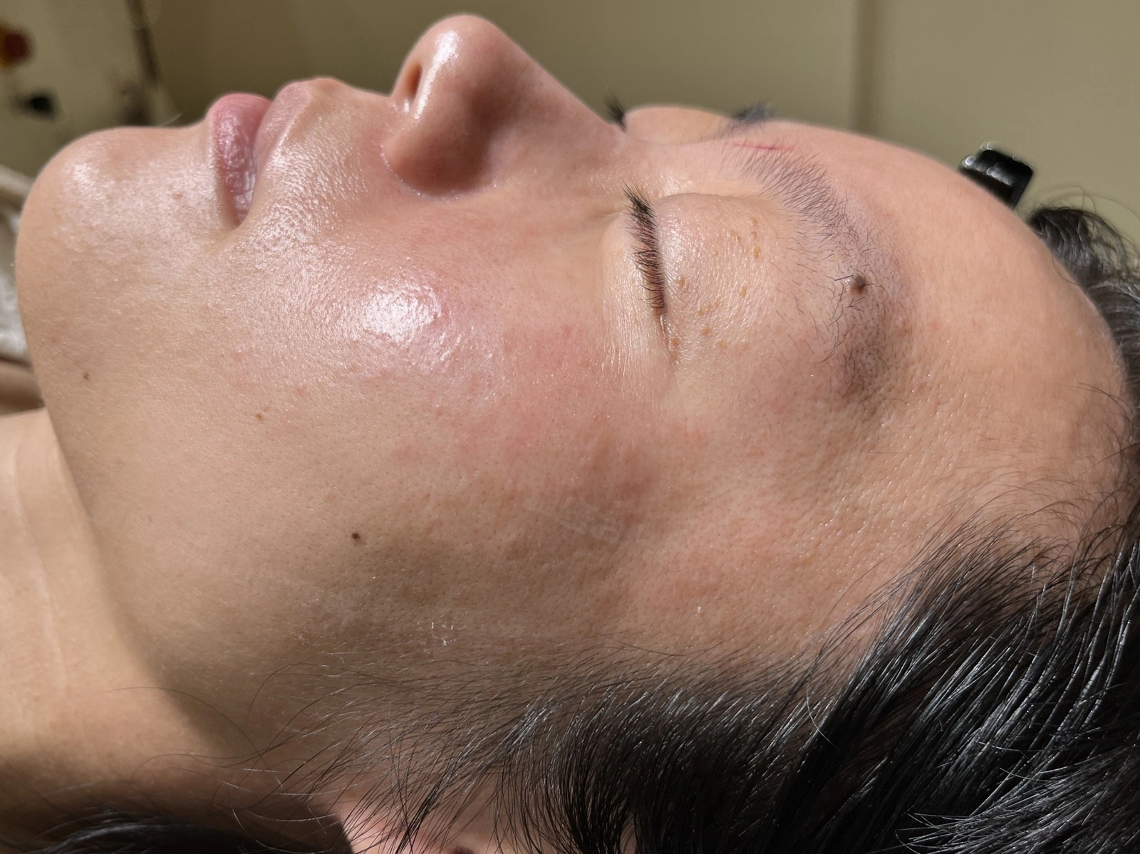 脂漏性角化症のレーザー治療10ヶ月後。炎症後色素沈着が消失し、肌の色調が改善した状態