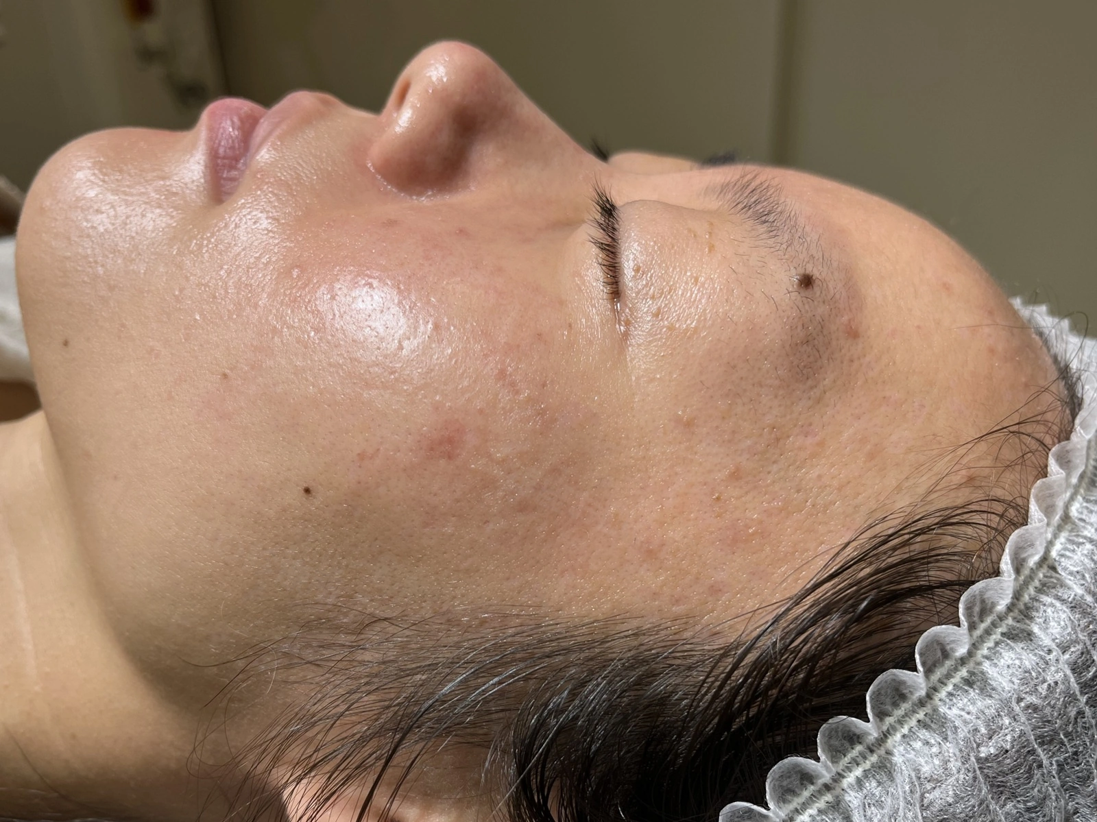 脂漏性角化症のレーザー治療2週間後。かさぶたはすべて取れ、軽い赤みと炎症後色素沈着が現れ始めている状態