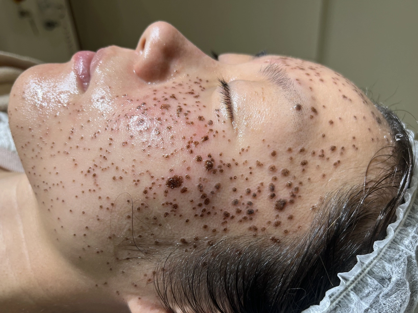 脂漏性角化症のレーザー治療直後。顔全体の多数の治療部位にかさぶたが形成されている状態