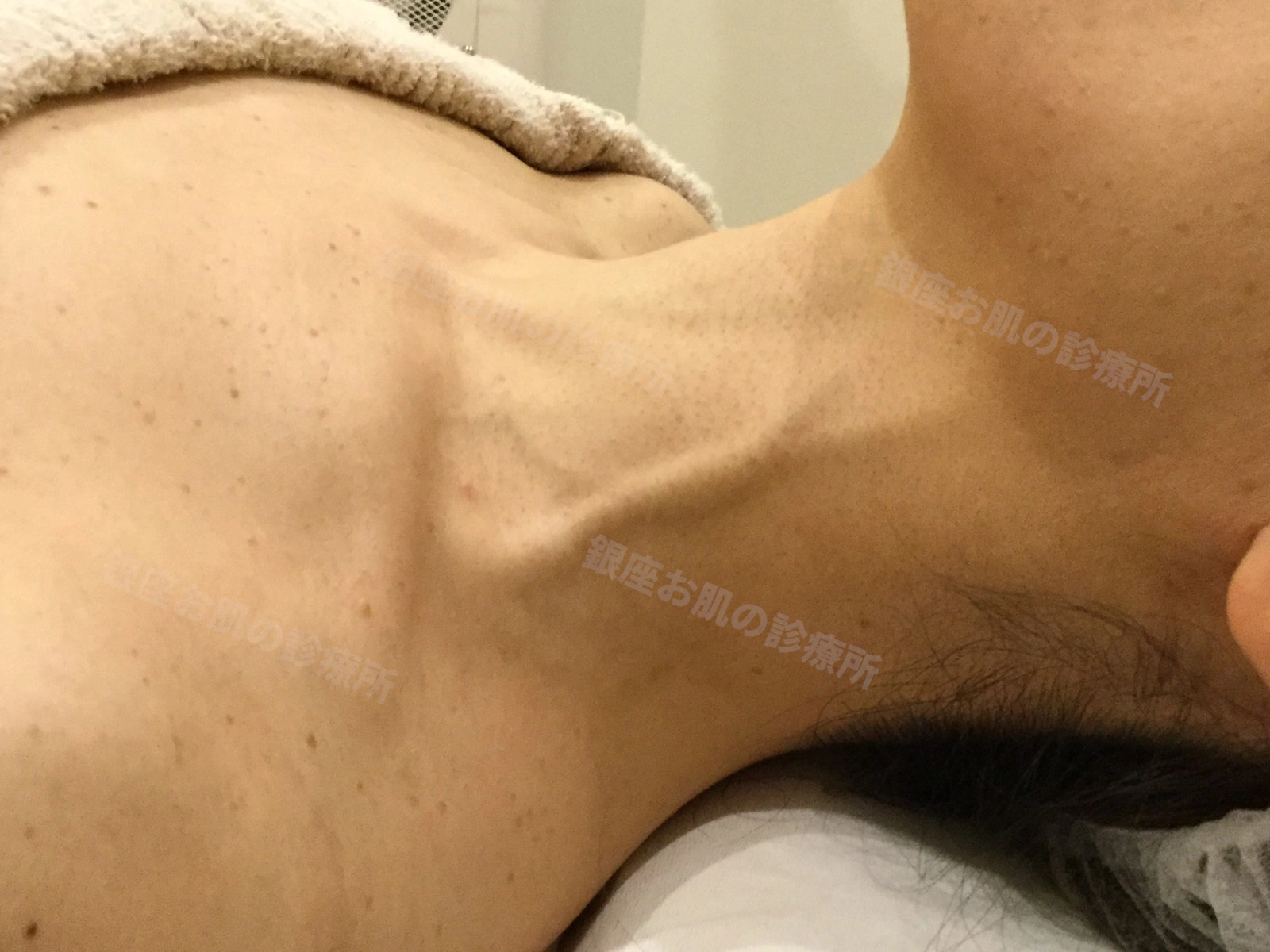 首(左側面)の脂漏性角化症のレーザー治療2ヶ月後。炎症後色素沈着はみられず、良好な状態