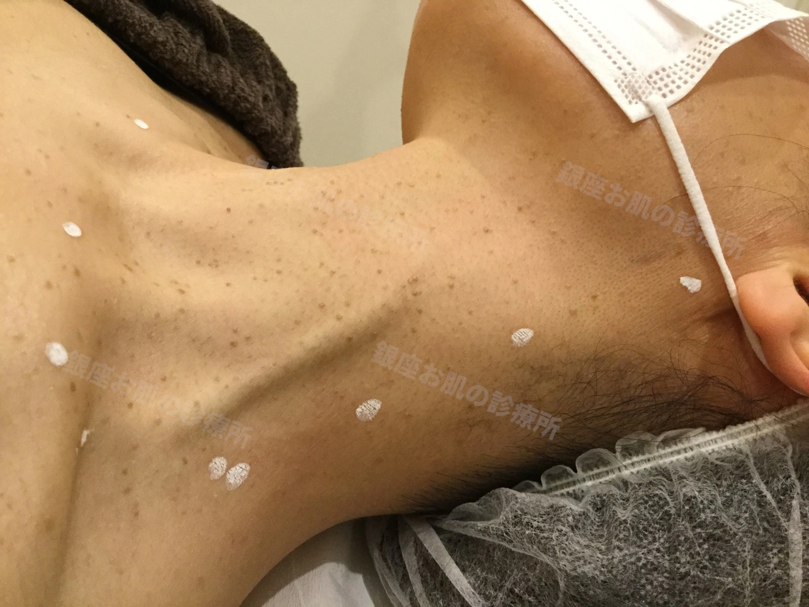 首(左側面)の脂漏性角化症のレーザー治療前。首に多数の脂漏性角化症がみられる状態