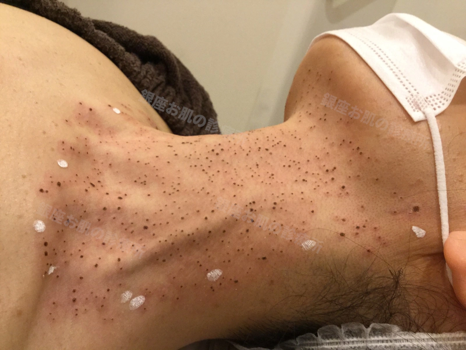 首(左側面)の脂漏性角化症のレーザー治療直後。多数の治療部位にかさぶたが形成されている状態