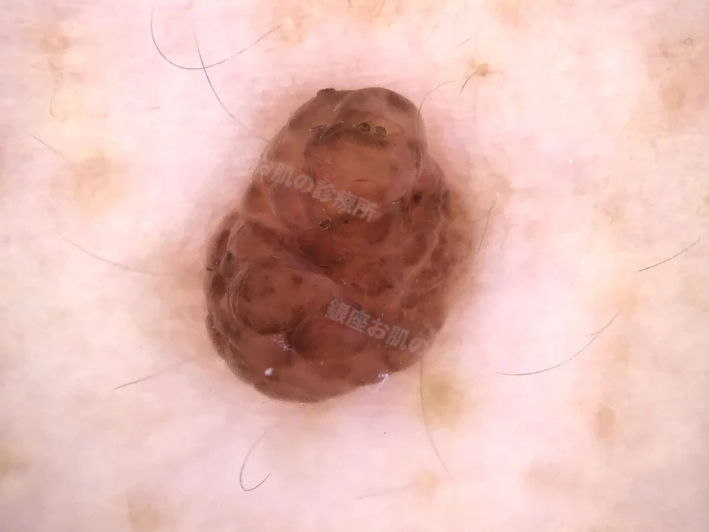 ほくろ（色素性母斑）の拡大画像。色調や表面の性状など、病変の細かな特徴が確認できる。