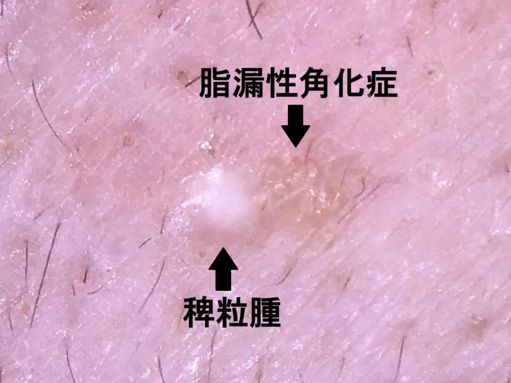 稗粒腫と脂漏性角化症が隣接してみられる拡大写真。両者の色調や表面の性状の違いが確認できる。