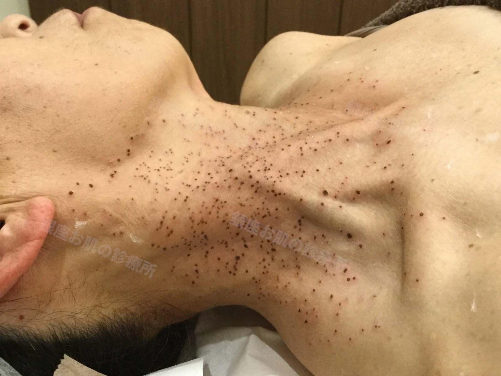 首の脂漏性角化症のレーザー治療直後。多数の治療部位にかさぶたが形成されている状態