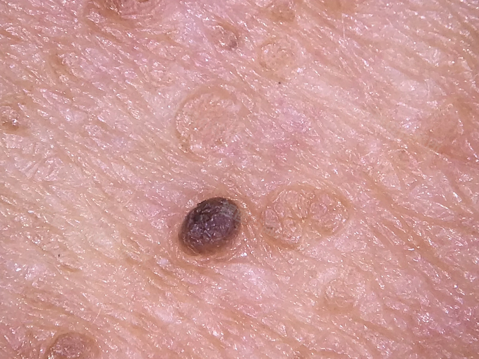 複数の脂漏性角化症の中に、有茎性脂漏性角化症が混在している臨床像