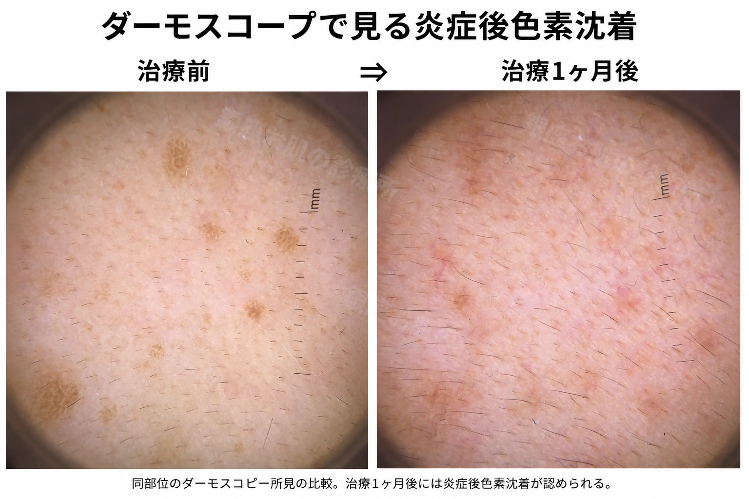 脂漏性角化症の治療前と治療1ヶ月後の同部位をダーモスコープで比較した画像。治療後に炎症後色素沈着が見られる