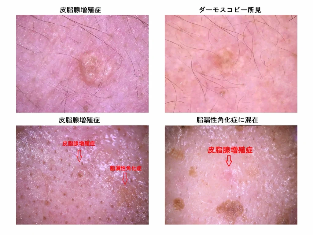 皮脂腺増殖症の複数の拡大写真。毛穴を中心に皮脂腺が増大し、周囲が周堤状に隆起している。脂漏性角化症に混在してみられることも多い