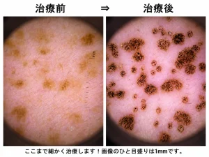 細かな脂漏性角化症のレーザー治療前後の比較画像。1mmの目盛りで、小さな病変まで治療している様子を示しています。