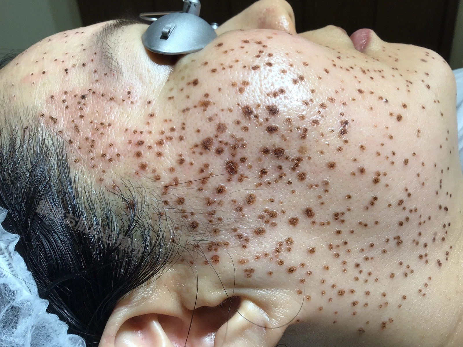 顔の脂漏性角化症をレーザー治療した直後の状態。多数の治療部位に痂皮が形成されている様子
