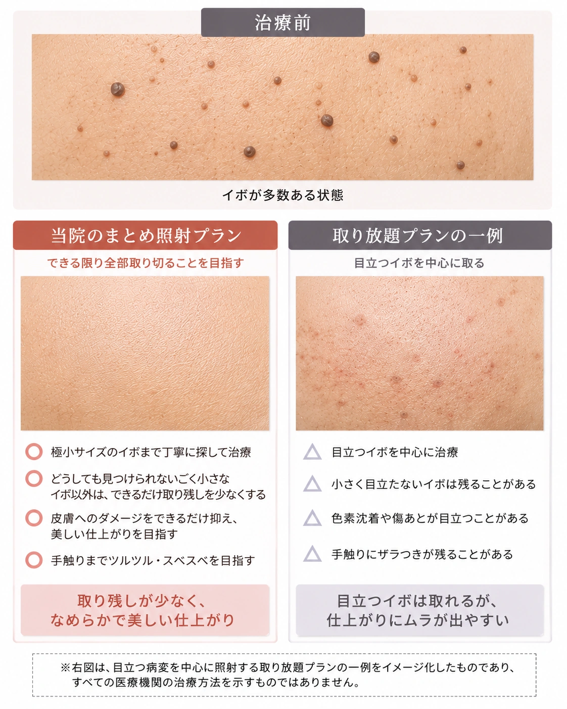 脂漏性角化症が多発する場合の当院のまとめ照射プランと、目立つイボを中心に治療する取り放題プランの仕上がりの違い