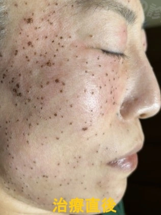 脂漏性角化症のレーザー治療直後の状態