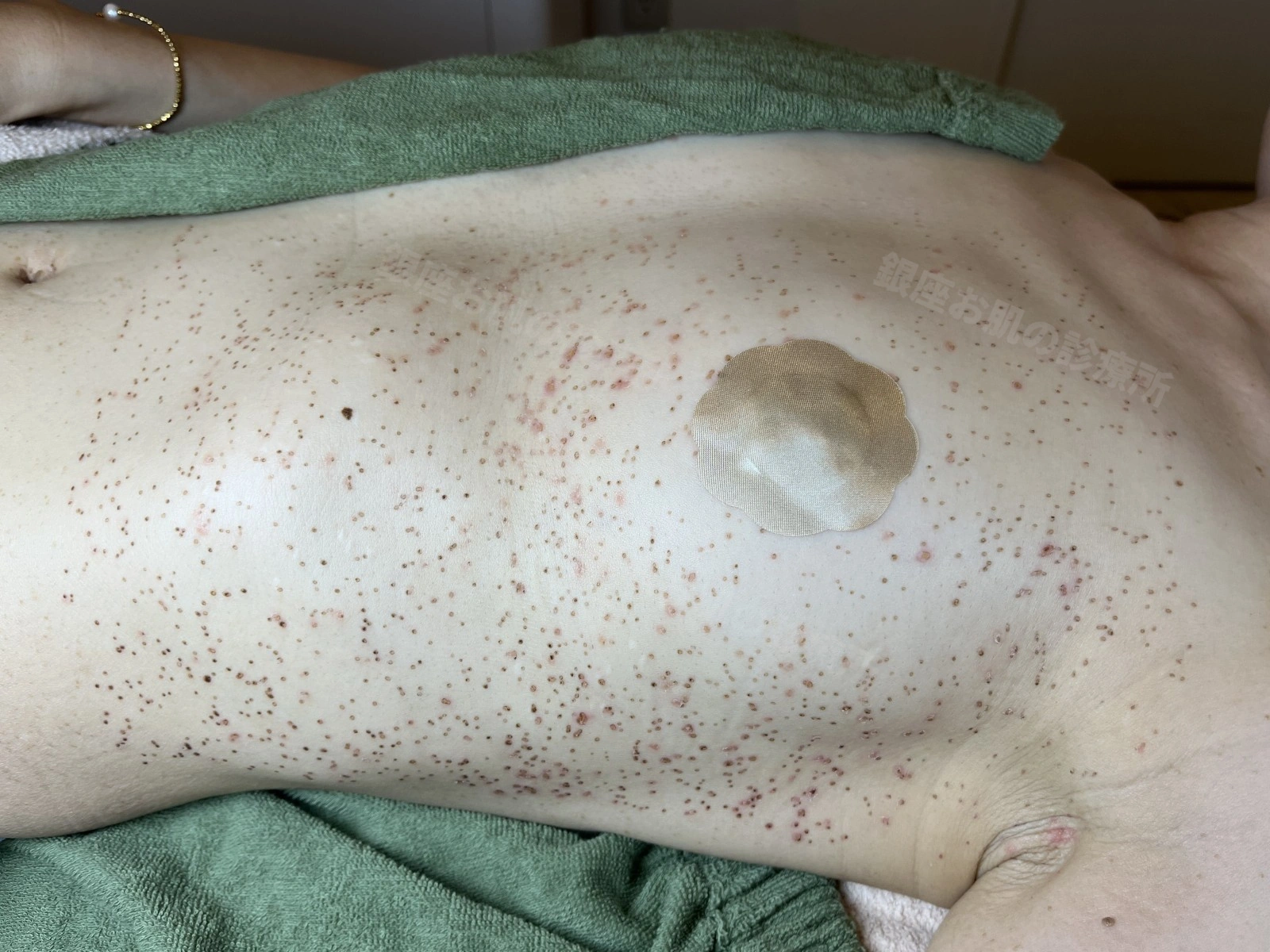 体幹部の脂漏性角化症のレーザー治療1週間後。まだかさぶたと赤みが残っている状態。