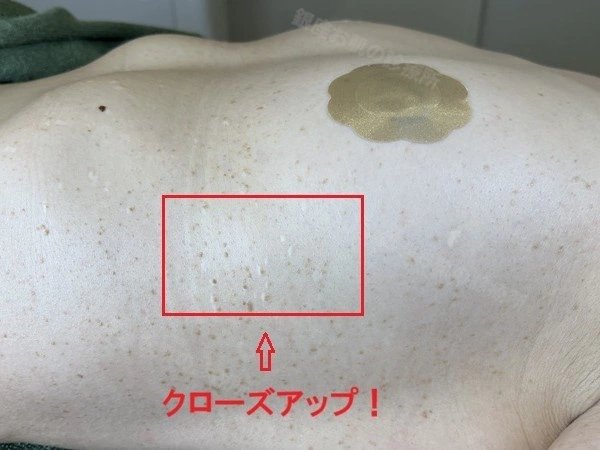 体幹部の脂漏性角化症のレーザー治療前。多数の脂漏性角化症が見られる状態