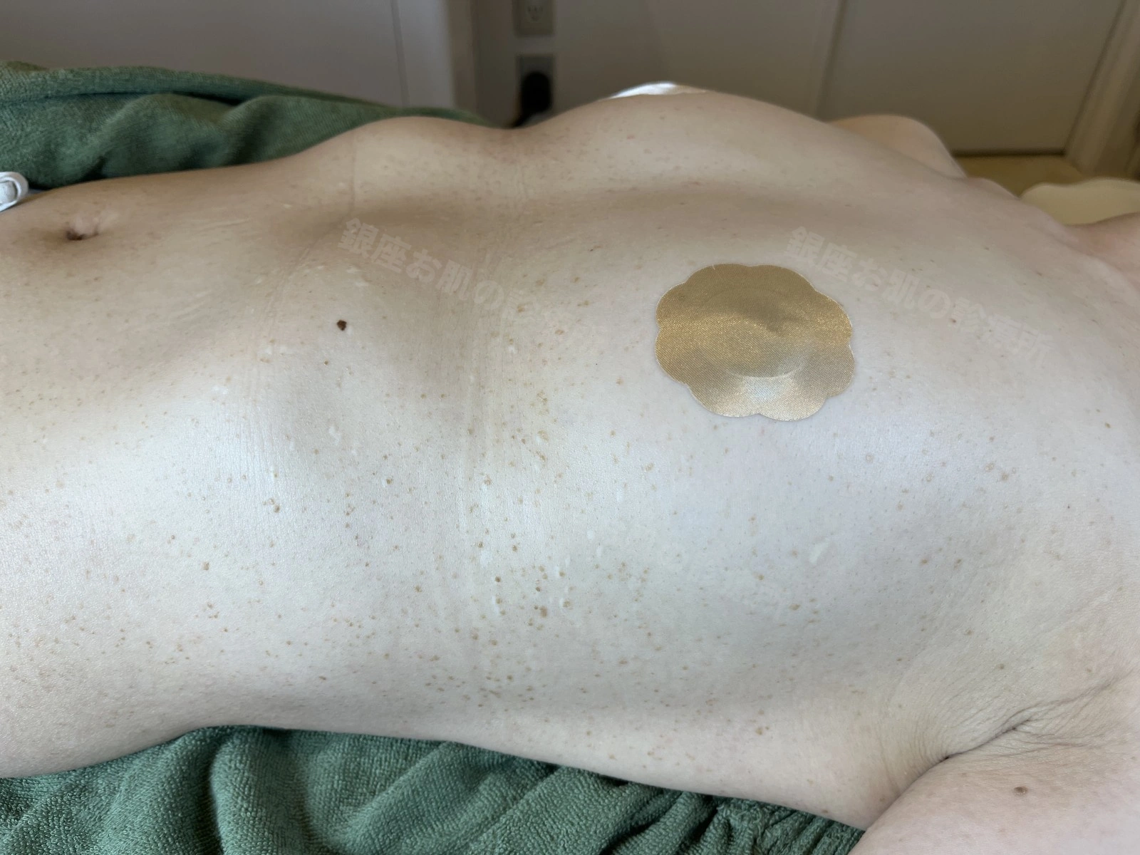 体幹部の脂漏性角化症のレーザー治療前。胸部から腹部に多数の脂漏性角化症がみられる状態