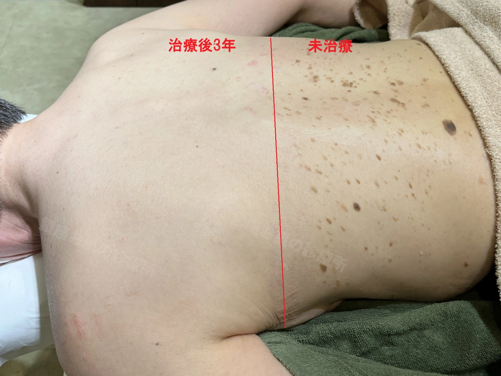 背中の脂漏性角化症で、レーザー治療3年後の上半分と未治療の下半分を比較した画像。治療済みの上半分では脂漏性角化症は見られず、目立つ瘢痕や色素沈着がほとんど見られない。未治療の下半分には多数の脂漏性角化症が残っている。