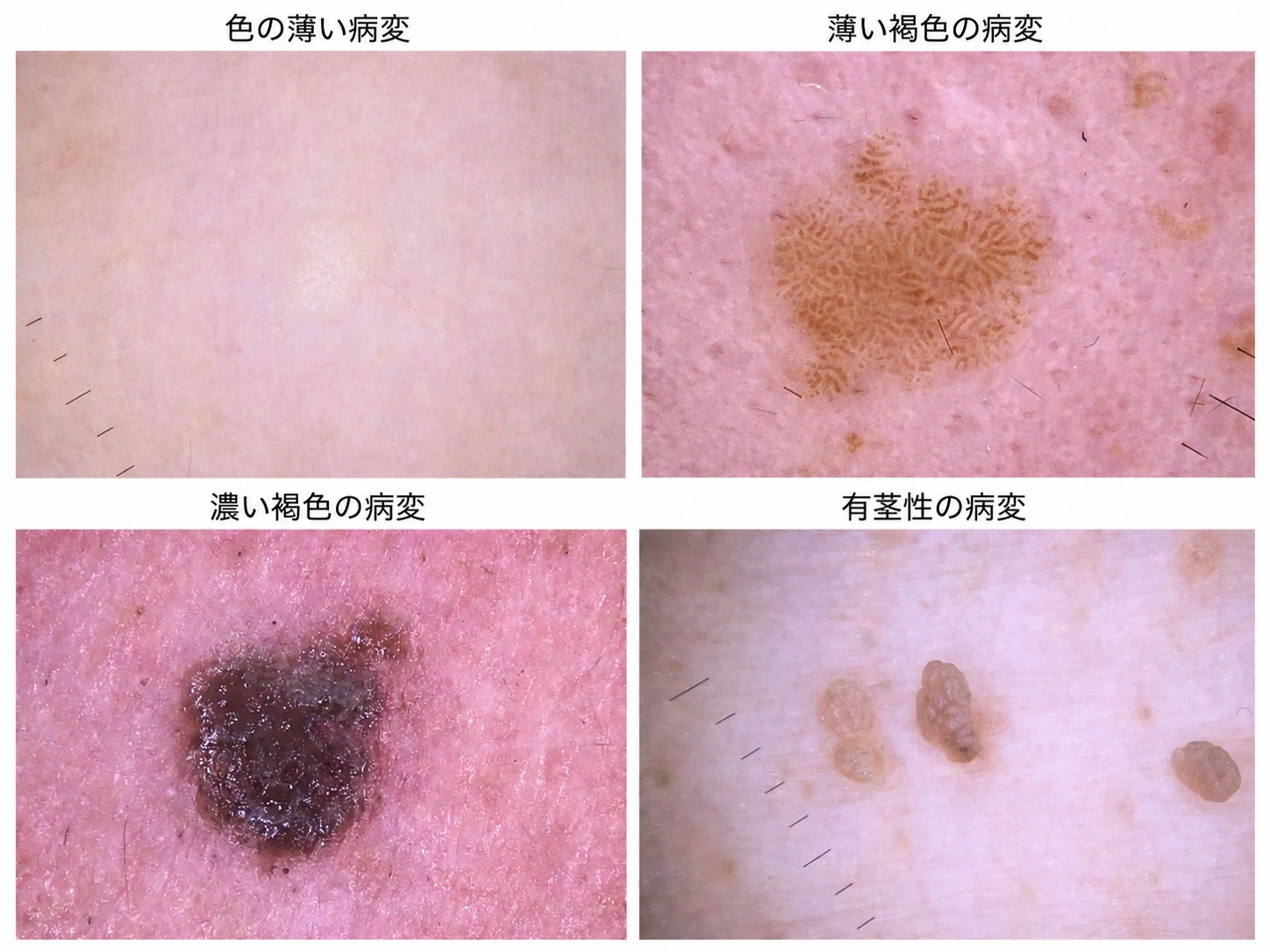 脂漏性角化症の複数の画像。色調、表面の所見、形、大きさ、隆起の程度はさまざまで、有茎性のものもみられる。